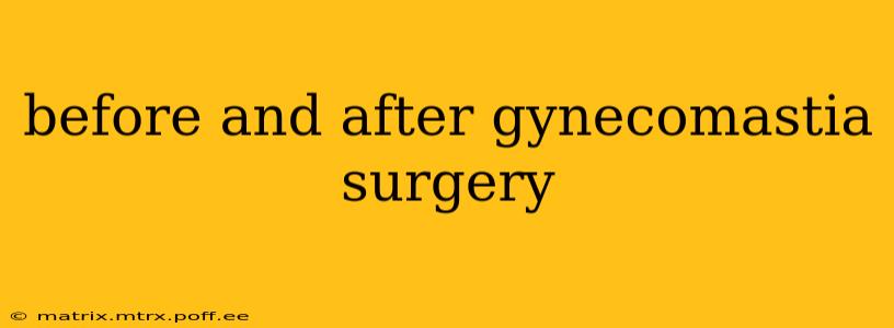 before and after gynecomastia surgery