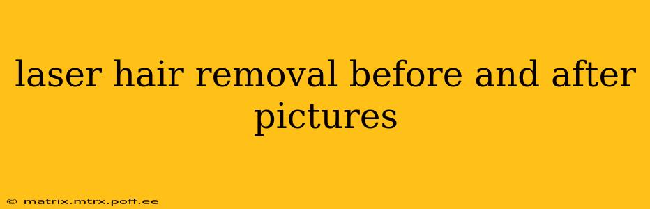 laser hair removal before and after pictures