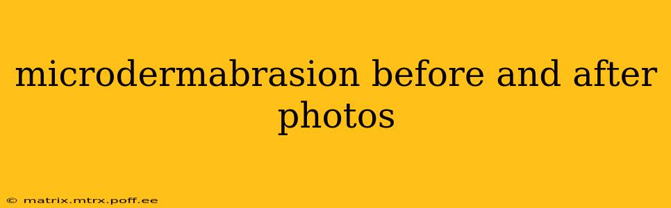 microdermabrasion before and after photos