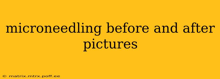 microneedling before and after pictures