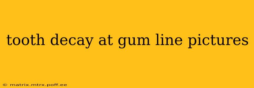 tooth decay at gum line pictures
