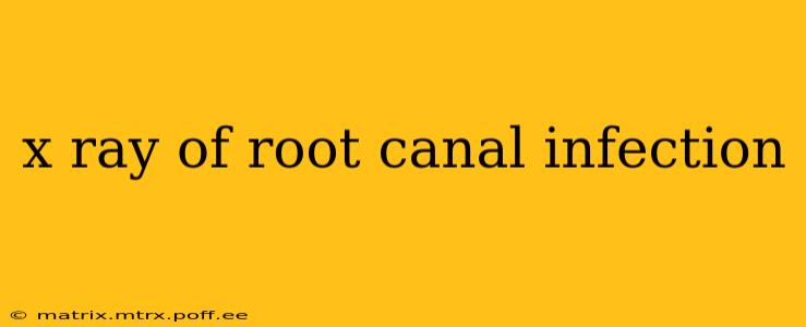 x ray of root canal infection